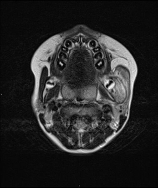 File:Chronic reactive multifocal osteomyelitis (CRMO) - mandible (Radiopaedia 56405-63069 Axial T2 13).jpg