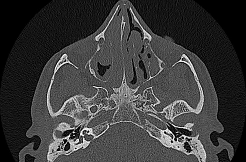 Chronic rhinosinusitis (Radiopaedia 65079-74075 Axial bone window 38).jpg
