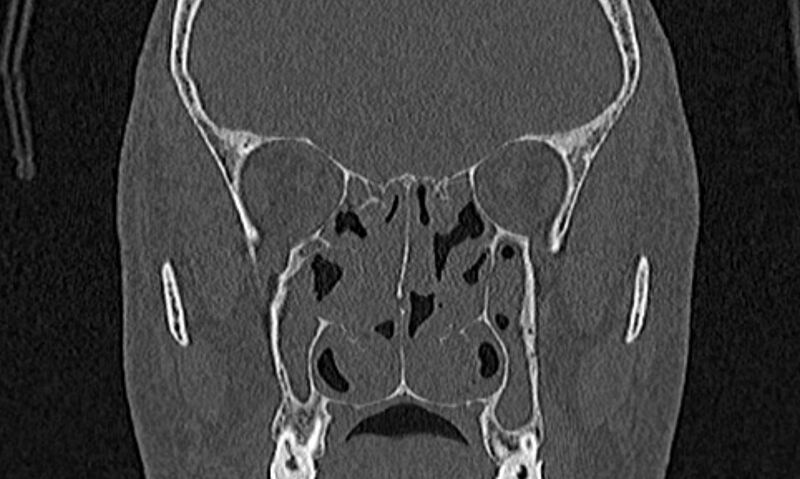 File:Chronic rhinosinusitis (Radiopaedia 65079-74075 Coronal bone window 46).jpg