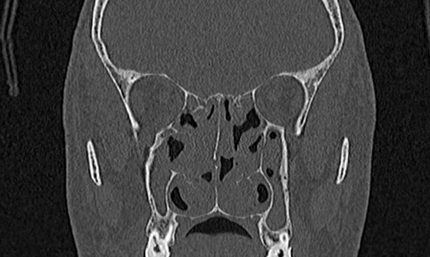 Chronic rhinosinusitis (Radiopaedia 65079-74075 Coronal bone window 46).jpg