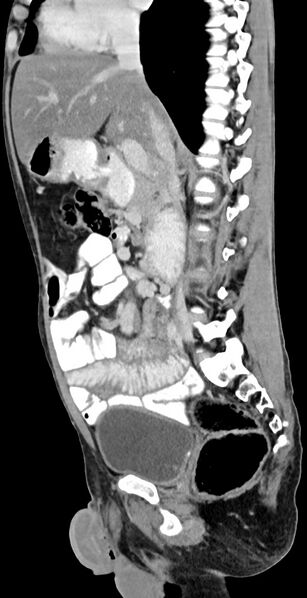 File:Chronic small bowel volvulus (Radiopaedia 75224-86322 C 84).jpg