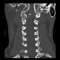 Clay-shoveler fracture (Radiopaedia 22568-22590 Coronal bone window 15).jpg
