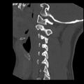 Clay-shoveler fracture (Radiopaedia 22568-22590 Sagittal bone window 11).jpg