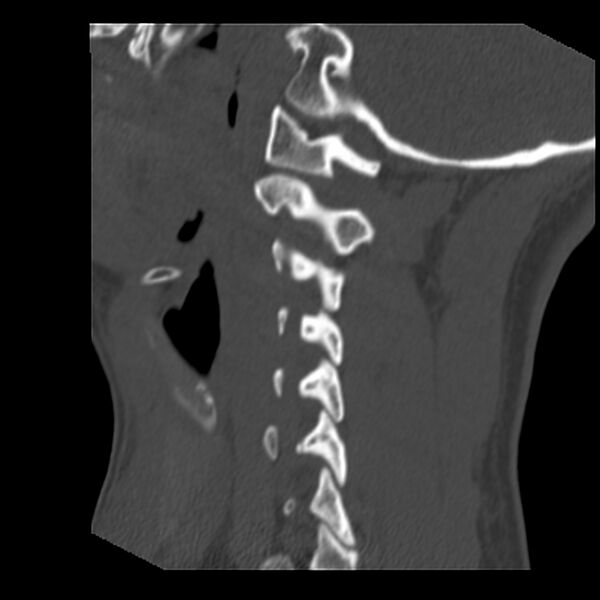 File:Clay-shoveler fracture (Radiopaedia 22568-22590 Sagittal bone window 11).jpg