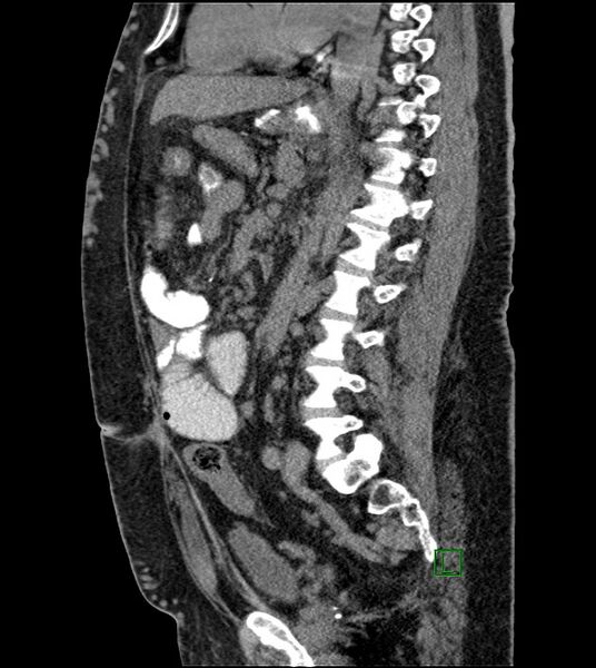 File:Closed-loop small bowel obstruction-internal hernia (Radiopaedia 78439-91096 C 69).jpg