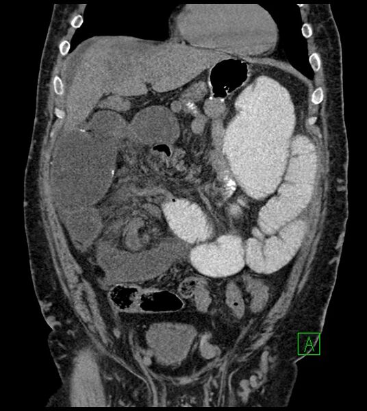 File:Closed-loop small bowel obstruction-internal hernia (Radiopaedia 78439-91096 Coronal non-contrast 37).jpg