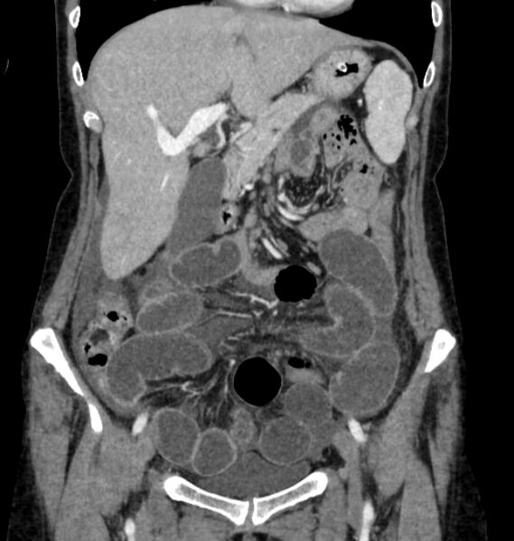 File:Closed loop small bowel obstruction (Radiopaedia 71211-81508 B 35).jpg