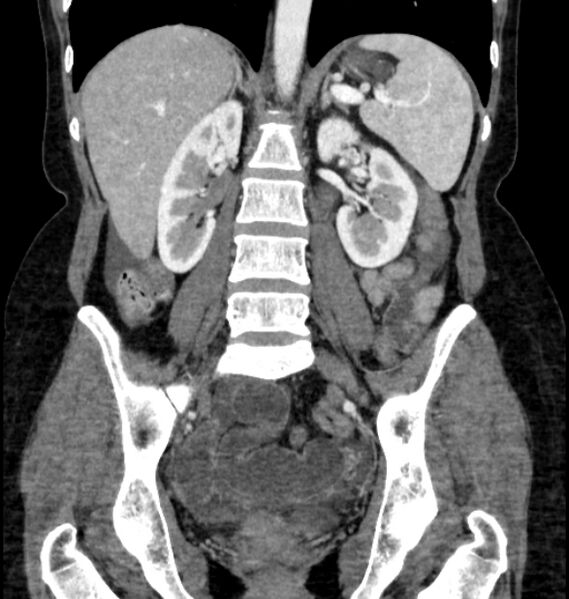 File:Closed loop small bowel obstruction (Radiopaedia 71211-81508 B 78).jpg