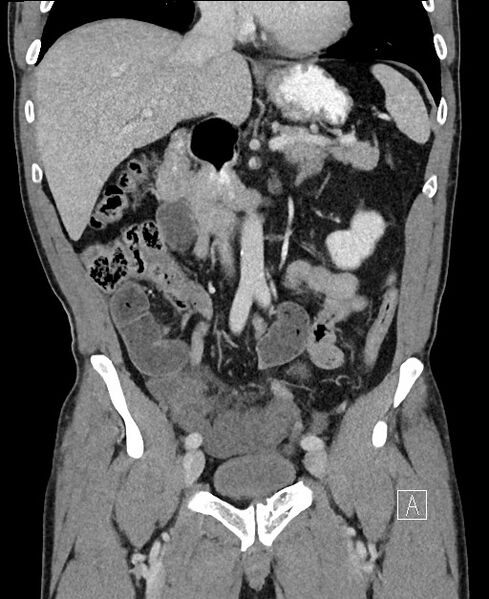 File:Closed loop small bowel obstruction - internal hernia (Radiopaedia 57806-64778 A 51).jpg