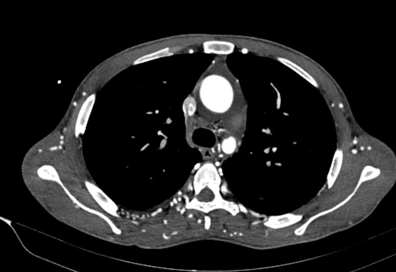 File:Coarctation of aorta with aortic valve stenosis (Radiopaedia 70463-80574 A 53).jpg