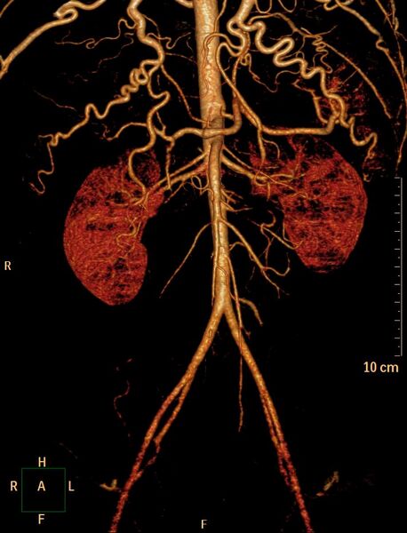 File:Coarctation of the aorta (Radiopaedia 27458-27657 3D 10).jpg
