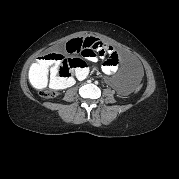 File:Cocoon abdomen with possible tubo-ovarian abscess (Radiopaedia 46235-50636 A 26).png