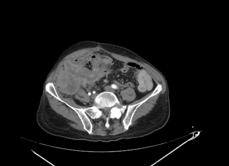 File:Colon cancer mimicking renal cell carcinoma (Radiopaedia 28986-29335 B 54).jpg