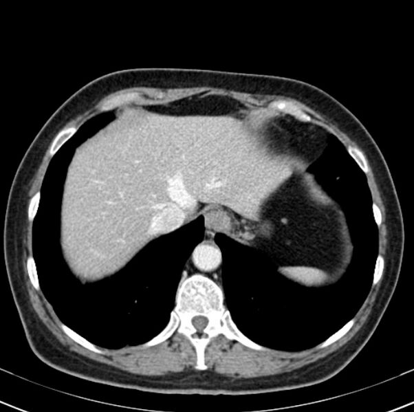 File:Colon carcinoma with hepatic metastases (Radiopaedia 29477-29961 A 14).jpg