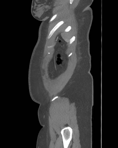 File:Colonic pseudo-obstruction (Radiopaedia 79752-92980 C 68).png