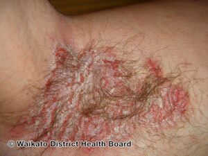 Hailey Hailey disease in axilla (DermNet NZ hailey-hailey-axilla2).jpg