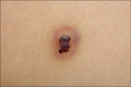 A dark brown papule with ecchymotic halo on left upper back