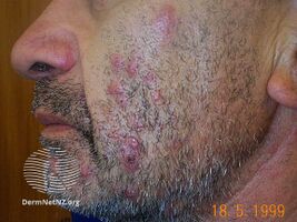 Chloracne/Inflammatory lesions
