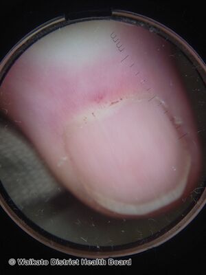 Nail fold capillary telangiectasia (DermNet NZ nail-fold-capillary-telangiectasia-wdhb-v2).jpg