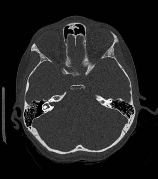 File:Nasoorbitoethmoid fracture (Radiopaedia 90044-107205 Axial bone window 85).jpg