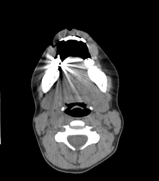 File:Nasoorbitoethmoid fracture (Radiopaedia 90044-107205 Axial non-contrast 61).jpg