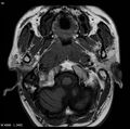 Nasopharyngeal carcinoma (Radiopaedia 4546-6667 Axial T1 10).jpg