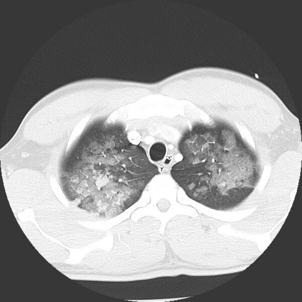 File:Near drowning pulmonary edema (Radiopaedia 16868-16591 Axial lung window 4).jpg