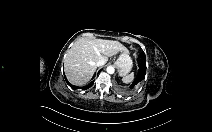 Neo-terminal ileal stricture (Crohn disease) (Radiopaedia 33790-34948 A 67).jpg