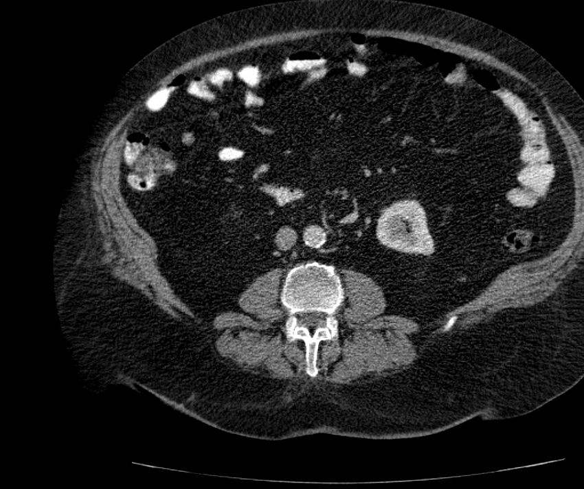 Nephroptosis with inguinal hernia containing perirenal fat (Radiopaedia 56632-63391 C 180).jpg