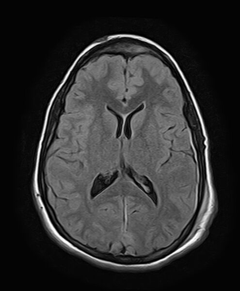 File:Neurofibromatosis type 2 (Radiopaedia 66211-75401 Axial FLAIR 18).jpg