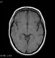 Neurosarcoidosis (Radiopaedia 10930-11351 Axial T1 9).jpg