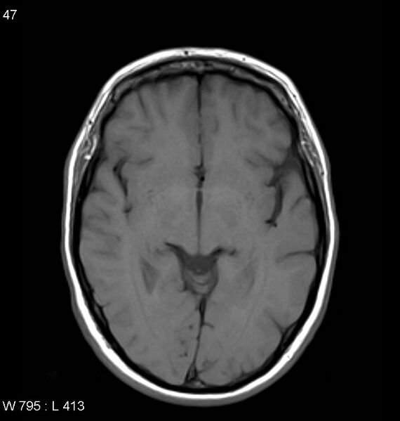 File:Neurosarcoidosis (Radiopaedia 10930-11351 Axial T1 9).jpg