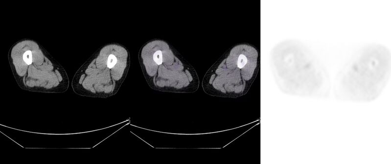File:Non-Hodgkin lymphoma involving seminal vesicles with development of interstitial pneumonitis during Rituximab therapy (Radiopaedia 32703-33752 ax CT Fus PET 75).jpg