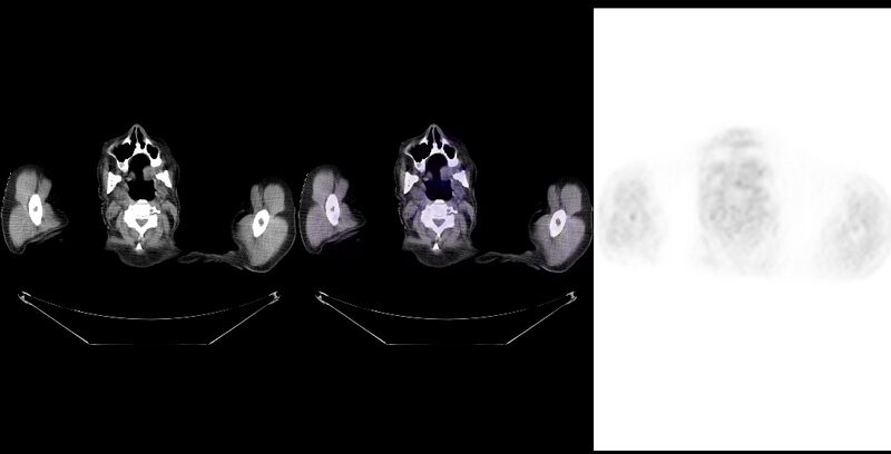 File:Non-Hodgkin lymphoma involving seminal vesicles with development of interstitial pneumonitis during Rituximab therapy (Radiopaedia 32703-33761 ax CT Fus PET 2).jpg
