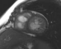 Non-compaction of the left ventricle (Radiopaedia 69436-79314 Short axis cine 103).jpg