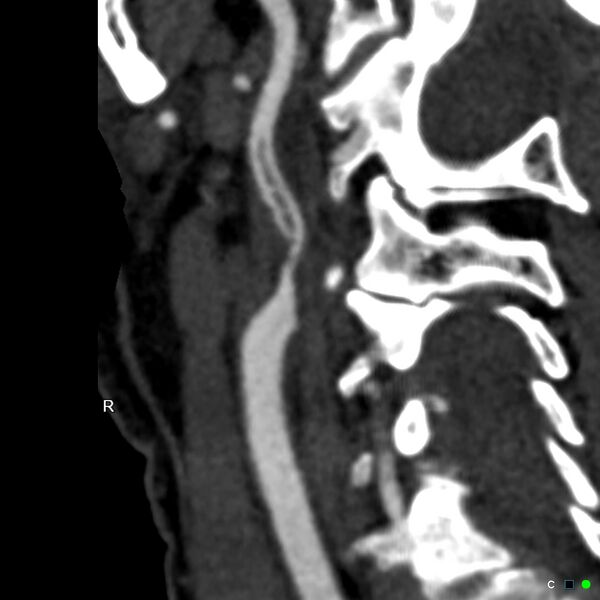 File:Non-occlusive intraluminal internal carotid artery thrombus (Radiopaedia 37751-39658 A 65).jpg