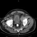 Non Hodgkin lymphoma in a patient with ankylosing spondylitis (Radiopaedia 84323-99621 Axial non-contrast 57).jpg