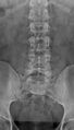 Normal AP lumbar spine radiograph (Radiopaedia 46420).jpg