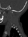 Normal CT cervical spine - pediatric (Radiopaedia 52549-58462 Sagittal bone window 10).jpg