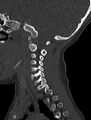 Normal CT cervical spine - pediatric (Radiopaedia 52549-58462 Sagittal bone window 150).jpg