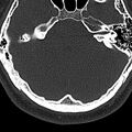 Normal CT of the cervical spine (Radiopaedia 53322-59305 Axial bone window 1).jpg