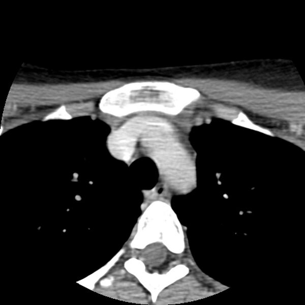 File:Normal CT of the neck (Radiopaedia 14575-14500 Axial C+ 75).jpg