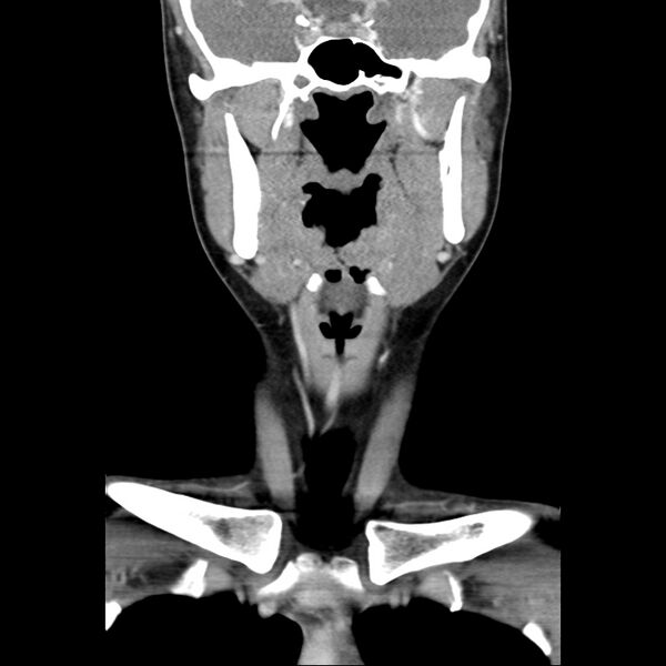 File:Normal CT of the neck (Radiopaedia 14575-14500 Coronal C+ 22).jpg