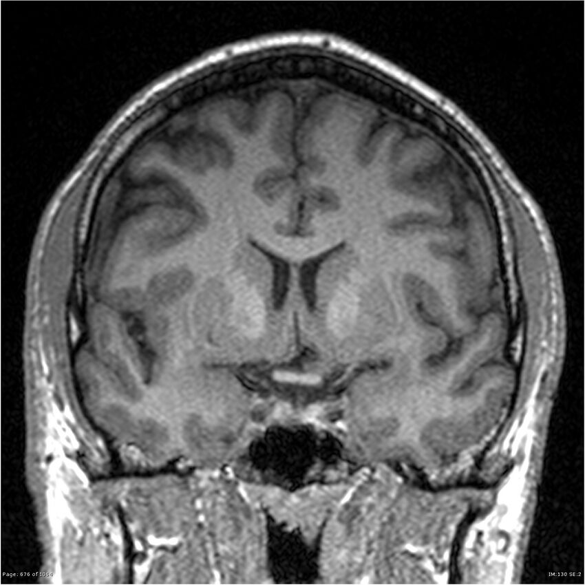 Normal brain MRI (non-focal epilepsy protocol) (Radiopaedia 38571-40700 Coronal T1 64).jpg