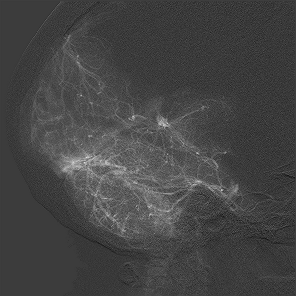 File:Normal cerebral angiogram (four vessel DSA) (Radiopaedia 41708-44649 L 16).png