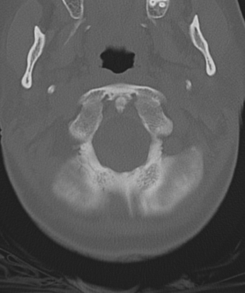 File:Normal cervical spine MRI (including Dixon) (Radiopaedia 42762-45926 Axial bone window 9).png