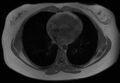 Normal liver MRI with Gadolinium (Radiopaedia 58913-66163 Axial T1 in-phase 34).jpg