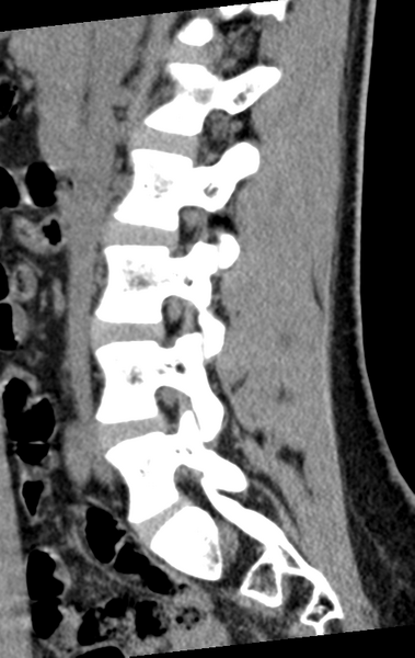 File:Normal lumbar spine CT (Radiopaedia 46533-50986 C 63).png