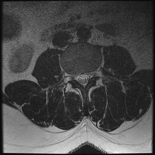 File:Normal lumbar spine MRI (Radiopaedia 43051-46311 Axial T2 11).jpg