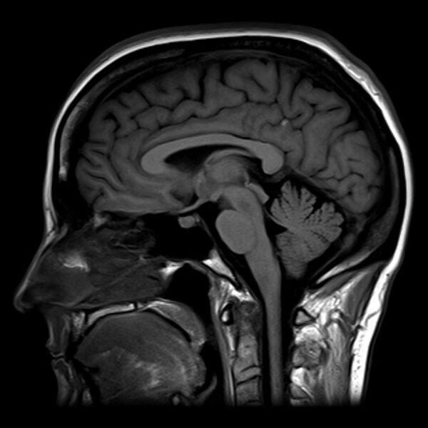 File:Normal midline brain (MRI) (Radiopaedia 2756).jpg